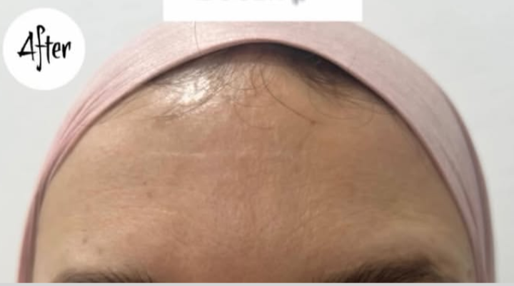 Après — Botox